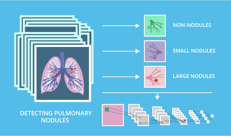 Detecting pulmonary nodules