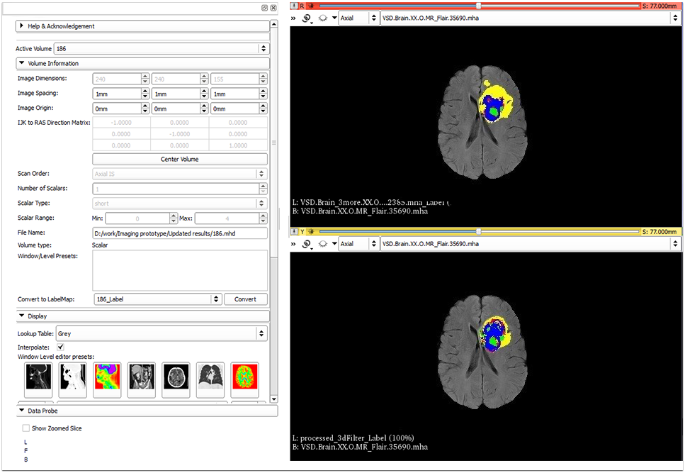 Brain tumor localization application