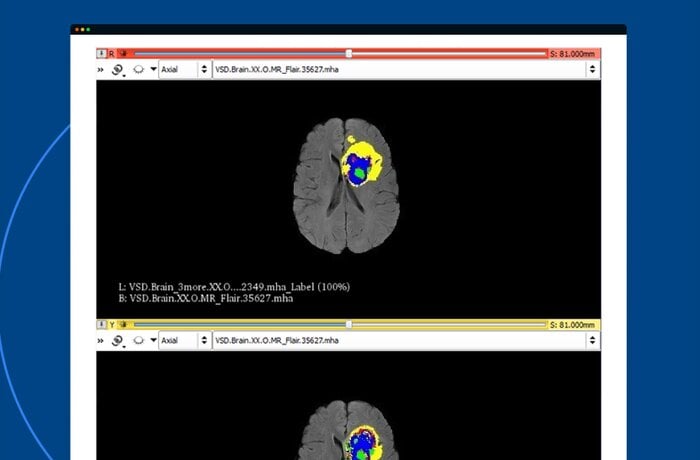 MRI Scans Analysis to Detect Brain Tumors Using CNN Algorithms