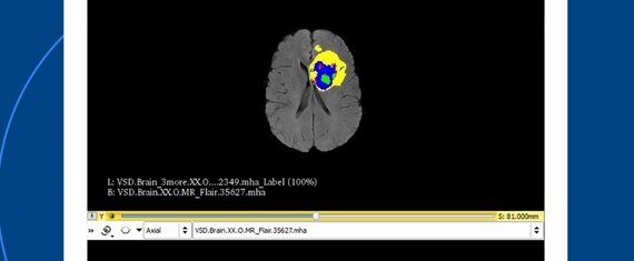 MRI Scans Analysis to Detect Brain Tumors Using CNN Algorithms