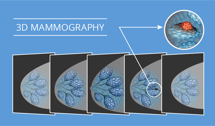 3D mammography
